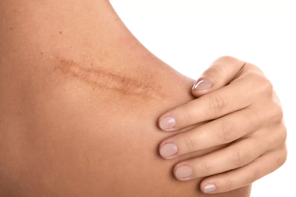 Scar Treatments